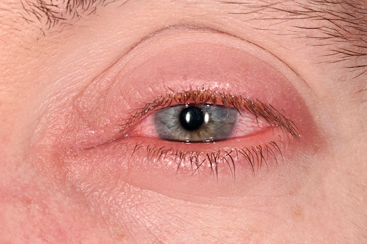 #3: Inflammation Anywhere in the Eye
