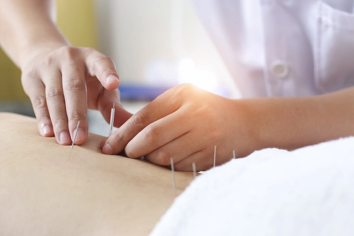 8. Try Acupuncture 8. Try Acupuncture