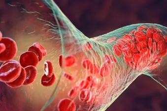 photo of blood clot