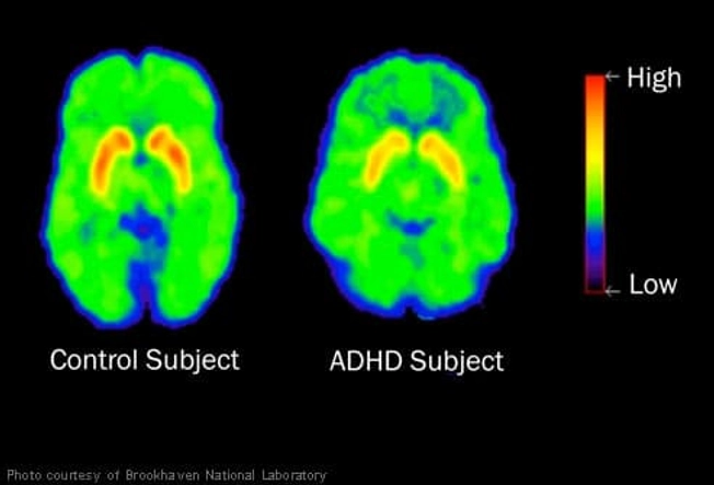 What Causes ADHD?