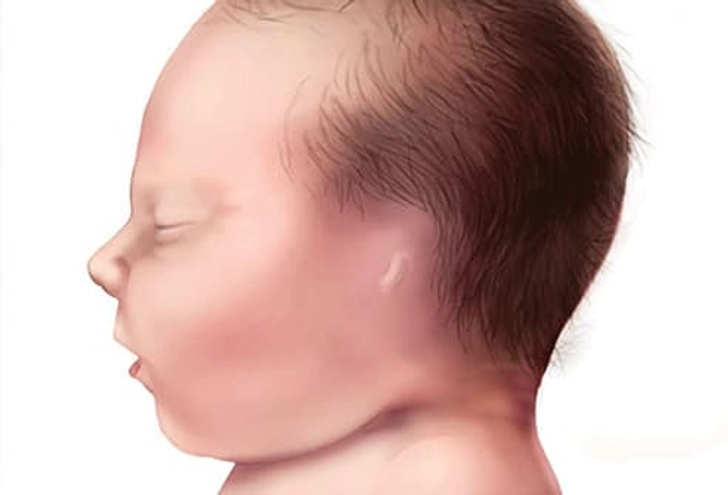 Missing External Ear Missing External Ear