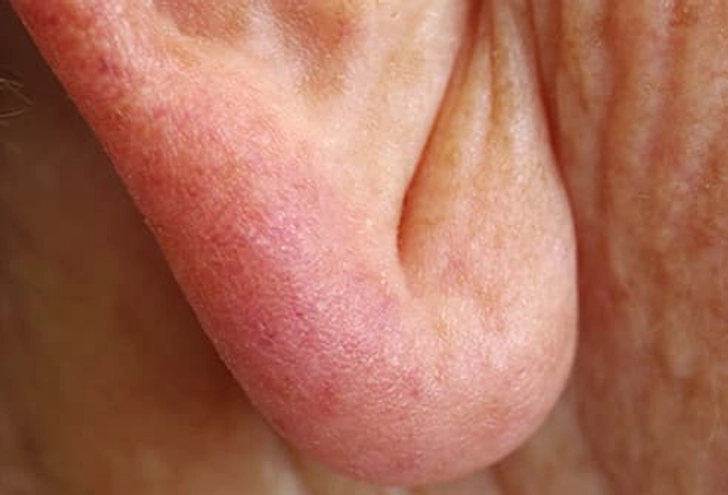 Earlobe Crease Earlobe Crease
