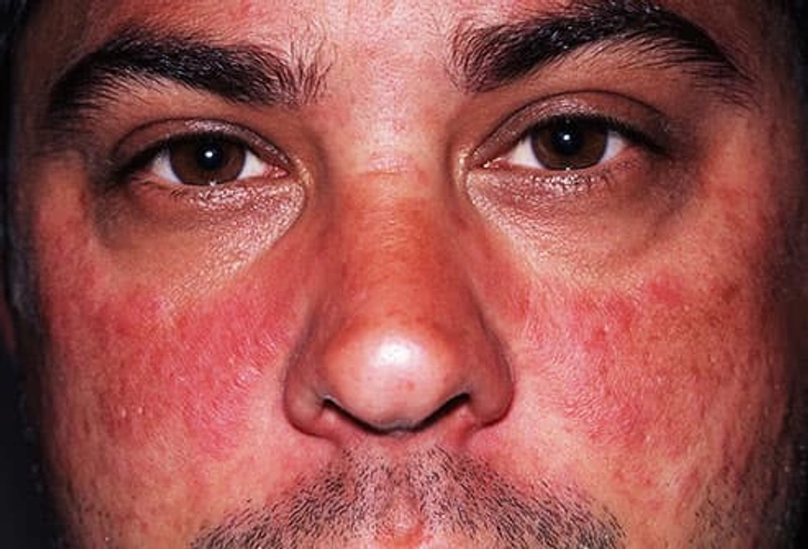 Butterfly Rash