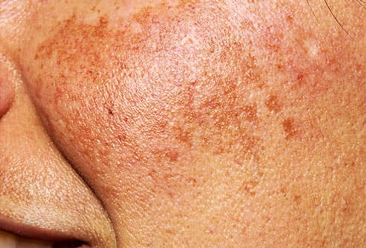 Melasma Melasma