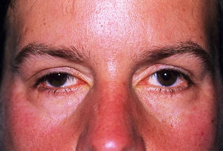 Drooping Eyelid Drooping Eyelid