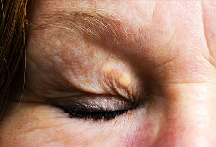 Yellow Spots on Your Eyelids