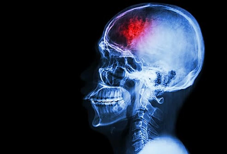 Facial Paralysis With Other Symptoms Facial Paralysis With Other Symptoms