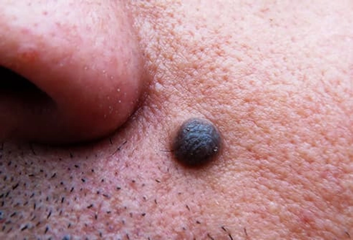 Moles Moles