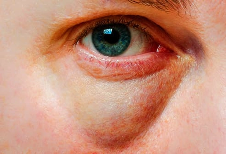 Puffy Eyes