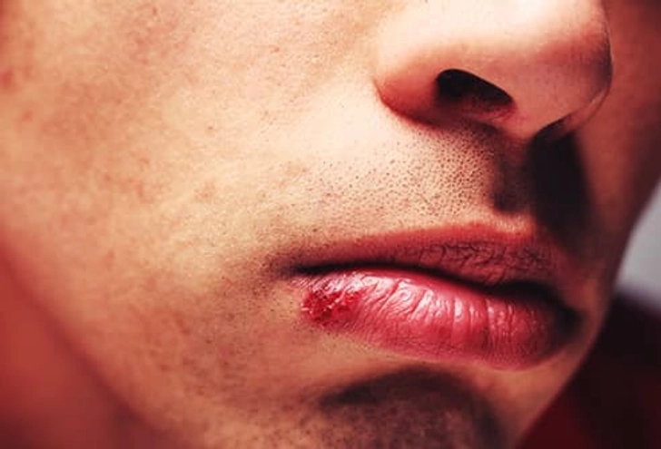Sores