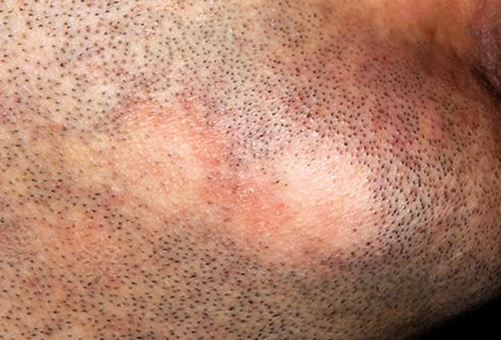 Hair Loss Hair Loss
