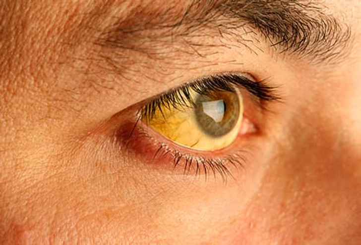 Yellowish Skin and Eyes Yellowish Skin and Eyes