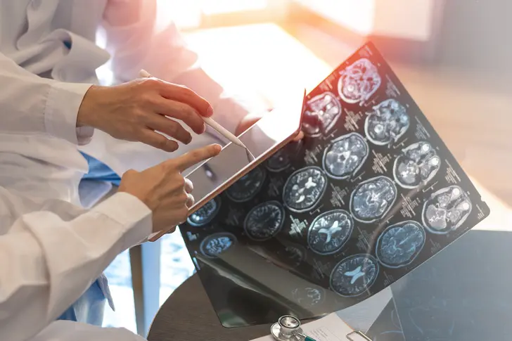 What Is MS?