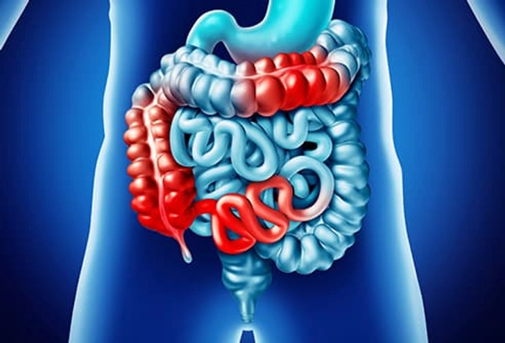 FODMAPs and Crohn’s Disease FODMAPs and Crohn’s Disease