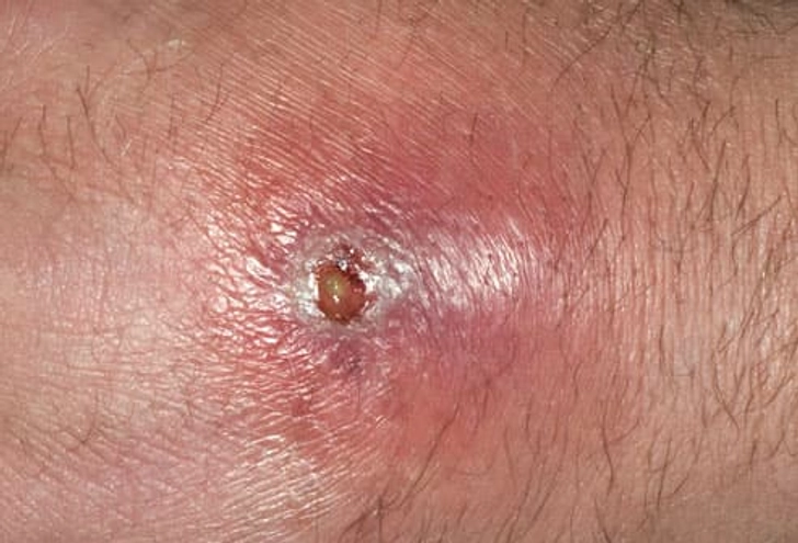 MRSA Skin Infection: Abscess