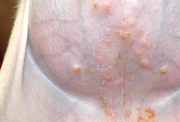 Impetigo Impetigo