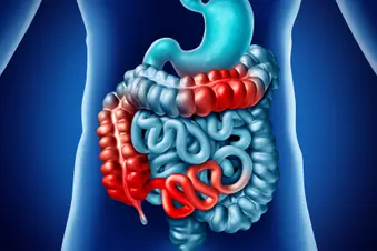 photo of Crohn's Disease