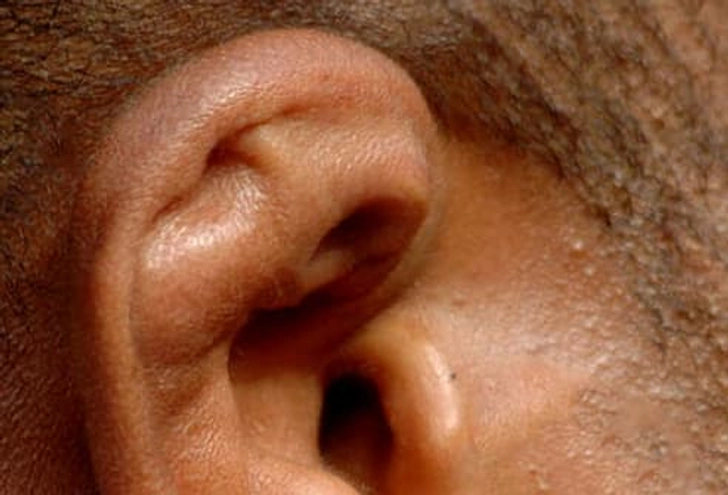 Cauliflower Ear