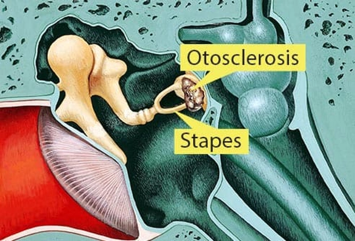 Otosclerosis