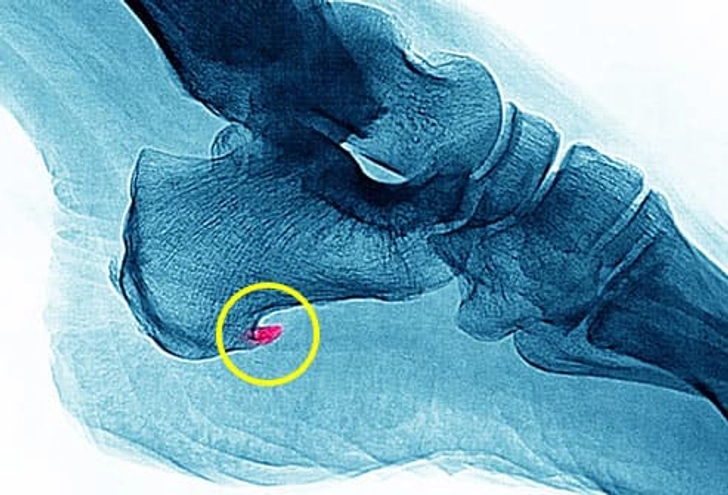 Enthesitis Enthesitis