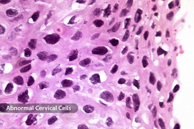 How HPV Causes Cervical Cancer