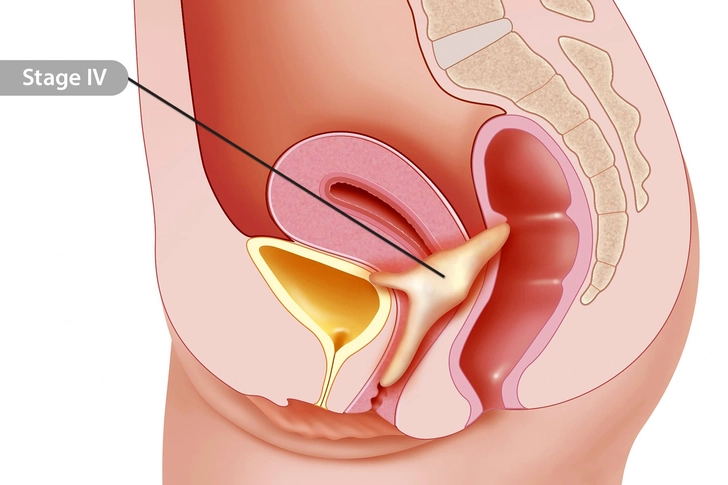 Stages of Cervical Cancer