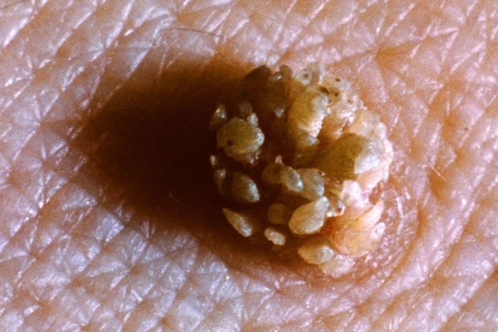 Symptoms of HPV