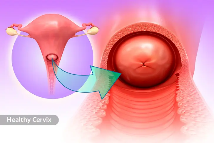 What Is Cervical Cancer?