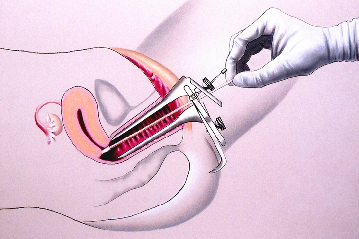 Early Detection: Pap Test Early Detection: Pap Test