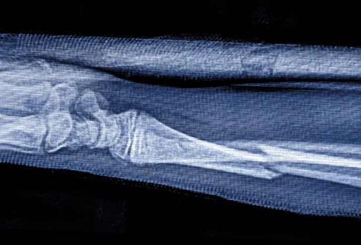 Symptom: Bone Fractures