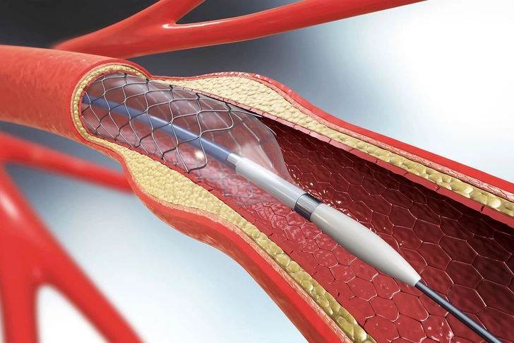 Can Surgery Help with PAD?