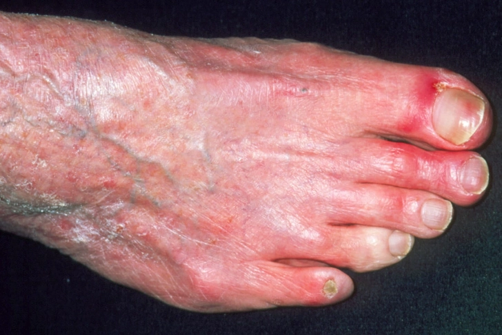 Advanced PAD Symptoms