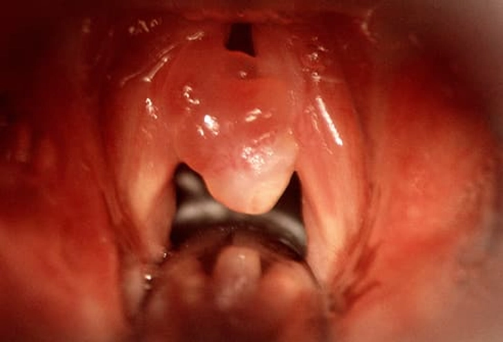 Vocal Cord Polyp