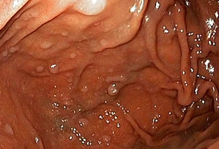 Stomach Polyps