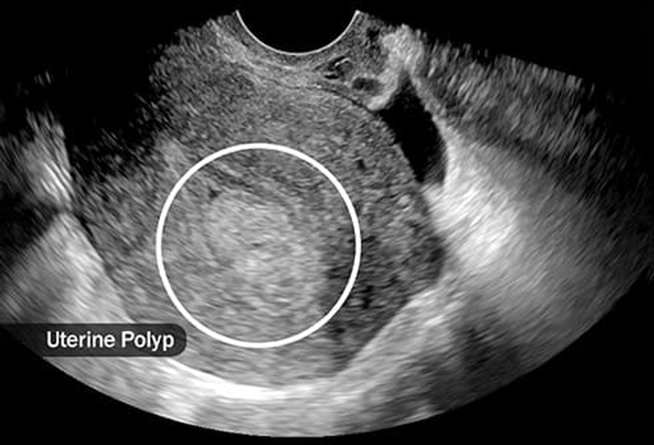 Uterine Polyps