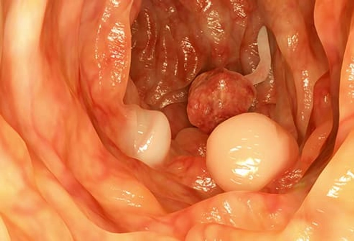 Colon Polyps