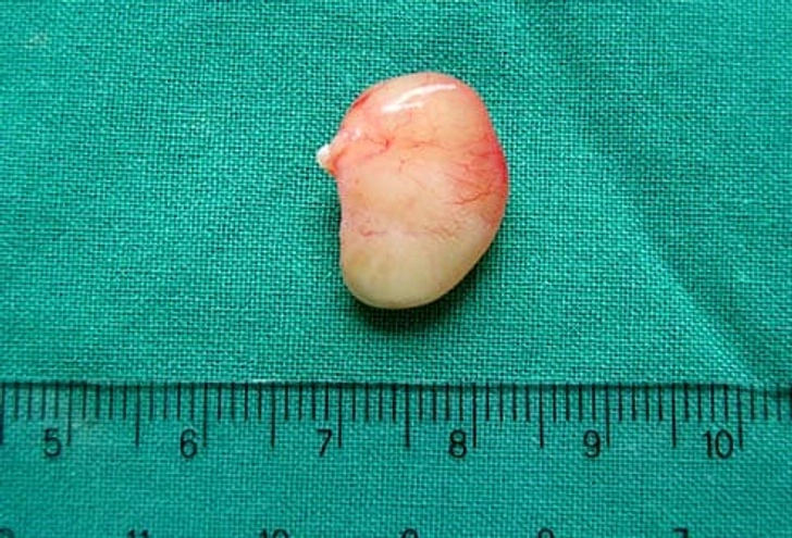 Nasal Polyps