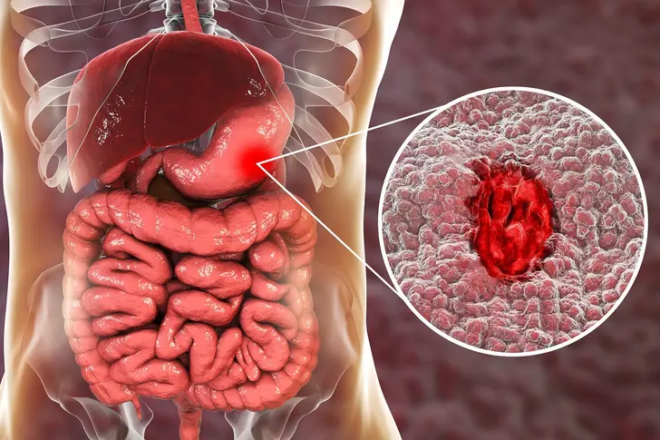 What Is an Ulcer? What Is an Ulcer?