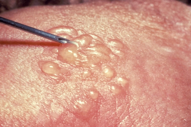 Genital Herpes Genital Herpes