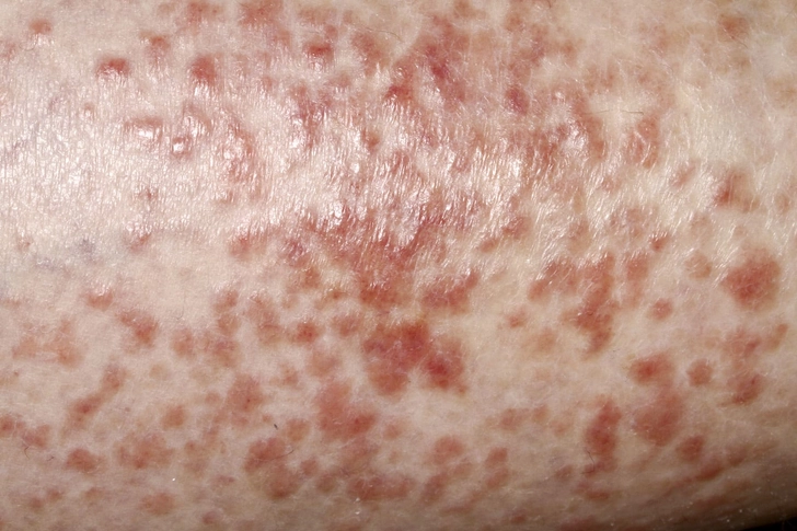 HIV Rash
