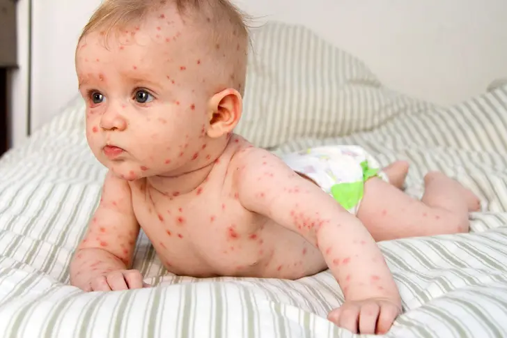 Chickenpox