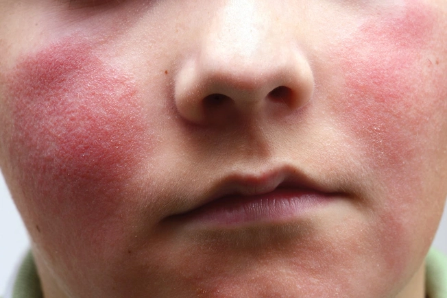 Fifth Disease Fifth Disease