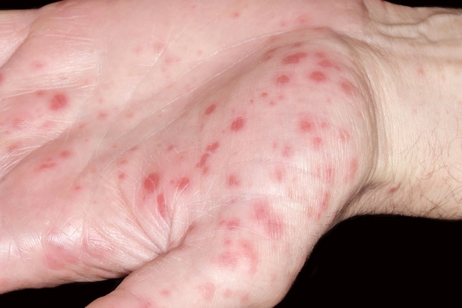 Hand-Foot-and-Mouth Disease Hand-Foot-and-Mouth Disease