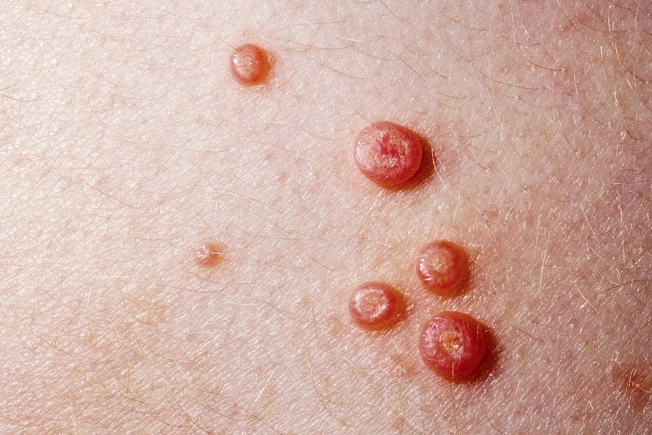 Molluscum Contagiosum Molluscum Contagiosum