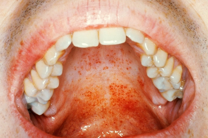 Mononucleosis