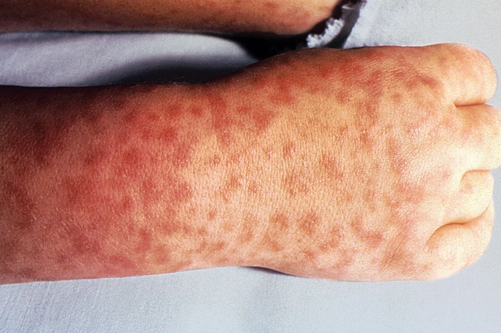Colorado Tick Fever