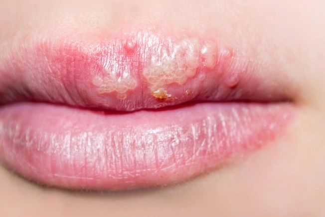 Cold Sores Cold Sores