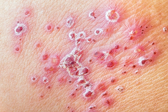 Shingles Shingles