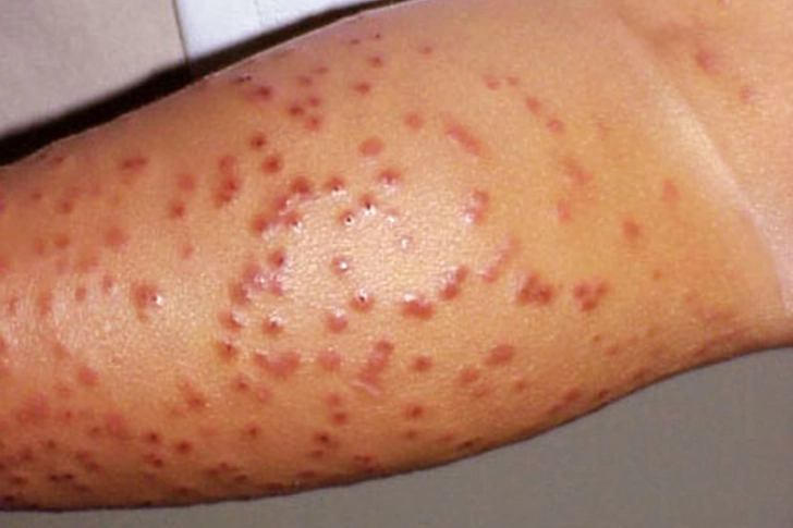 Acrodermatitis (Gianotti-Crosti Syndrome)