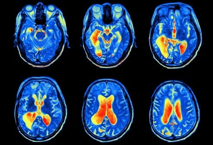 MRI MRI